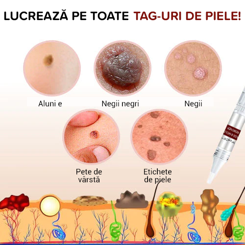 🌋New-Cremă în stilou pentru îndepărtarea furnicilor, Creta și negii de piele