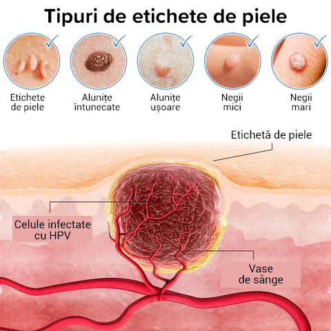 Elixir Creme pentru pete de piele, alunițe și veruci