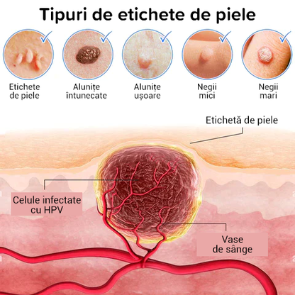 🌟Elixir Creme pentru pete de piele, alunițe și veruci ¬